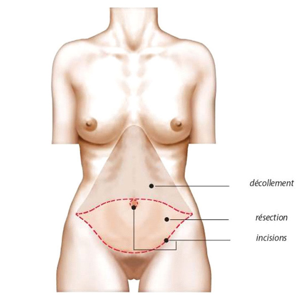 schéma abdominoplastie