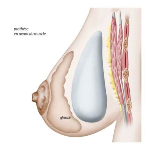 position prothèse sur muscle