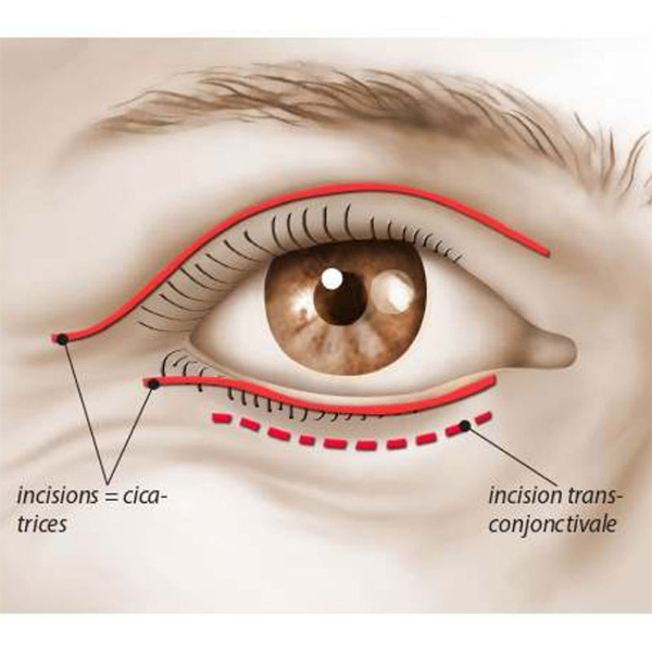 schéma intervention blépharoplastie