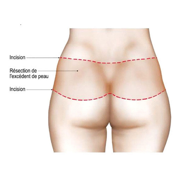 cicatrices bodylift