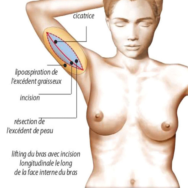 schema lifting du bras