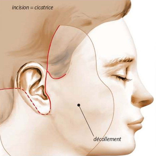 cicatrices lifting cervico-facial