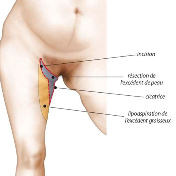 schema lifting des cuisses