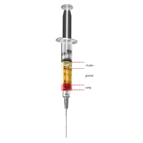 photo de seringue lipostructure des grandes lèvres