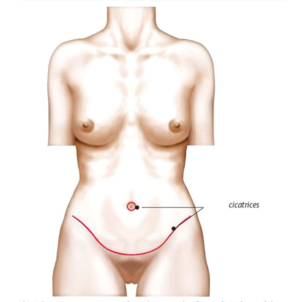 schéma abdominoplastie intervention