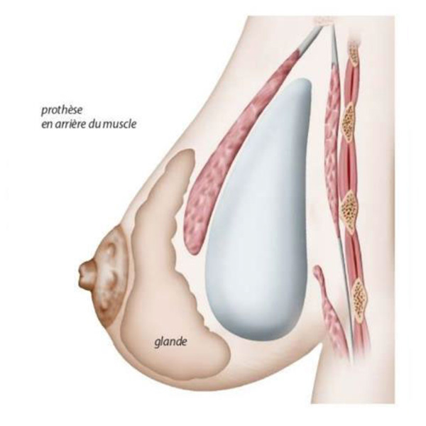 position prothèse sous le muscle