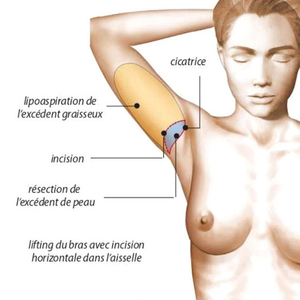 schema lifting du bras