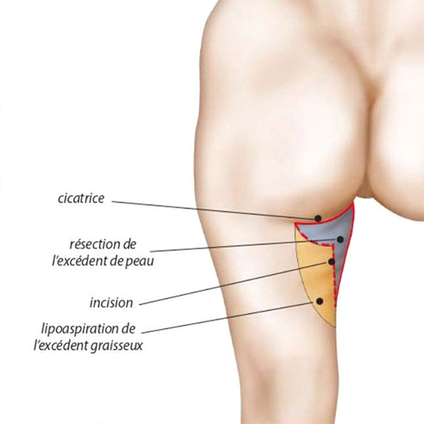 schema lifting des cuisses